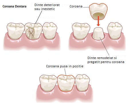 Piercingurile orale și pericolele dentare, Se pot răni articulațiile din cauza dinților